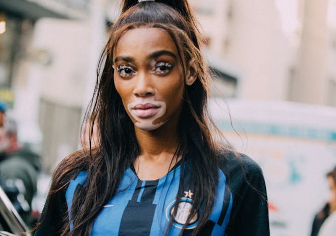 Winnie Harlow (Courtesy of Getty Images)